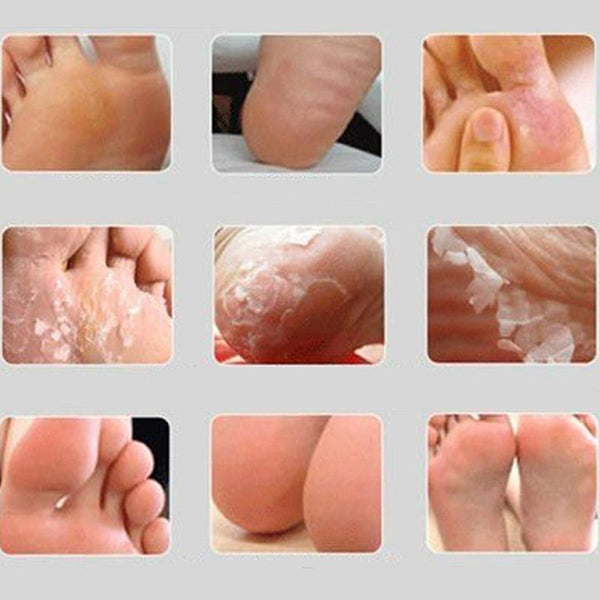 Baby Foot Peeling